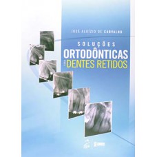 Soluções ortodônticas para dentes retidos